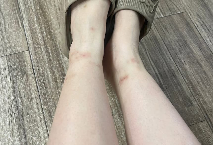 ベトナムで蚊に刺された足首と脛の赤い跡(在住者の実例)