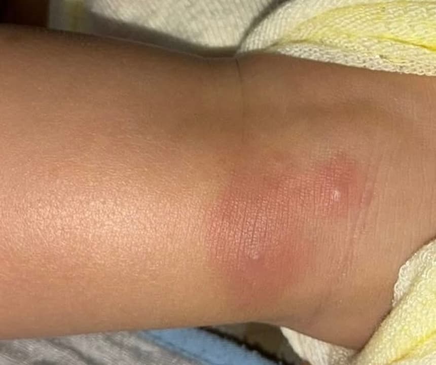 ベトナムで蚊に刺された子どもの腕の赤い跡